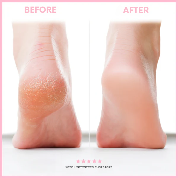 Foot Callus Exfoliator for Smooth, Soft Skin
